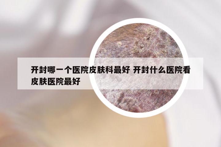 开封哪一个医院皮肤科最好 开封什么医院看皮肤医院最好