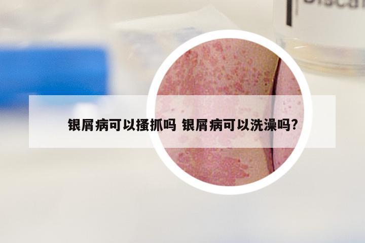 银屑病可以搔抓吗 银屑病可以洗澡吗?