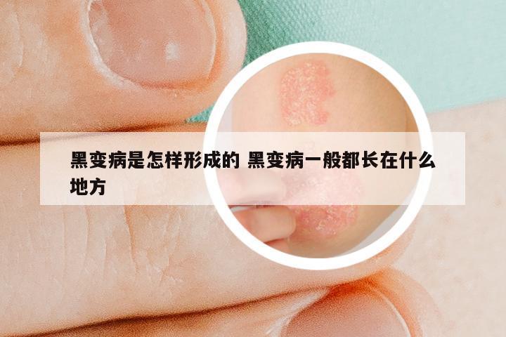 黑变病是怎样形成的 黑变病一般都长在什么地方