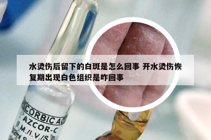 水烫伤后留下的白斑是怎么回事 开水烫伤恢复期出现白色组织是咋回事