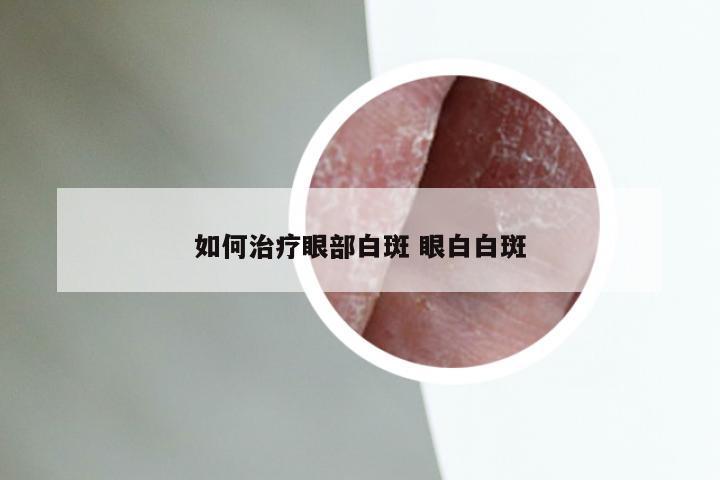 如何治疗眼部白斑 眼白白斑