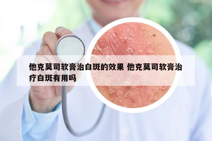 他克莫司软膏治白斑的效果 他克莫司软膏治疗白斑有用吗