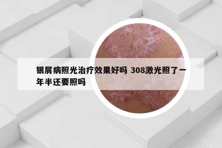 银屑病照光治疗效果好吗 308激光照了一年半还要照吗