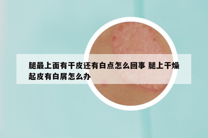 腿最上面有干皮还有白点怎么回事 腿上干燥起皮有白屑怎么办