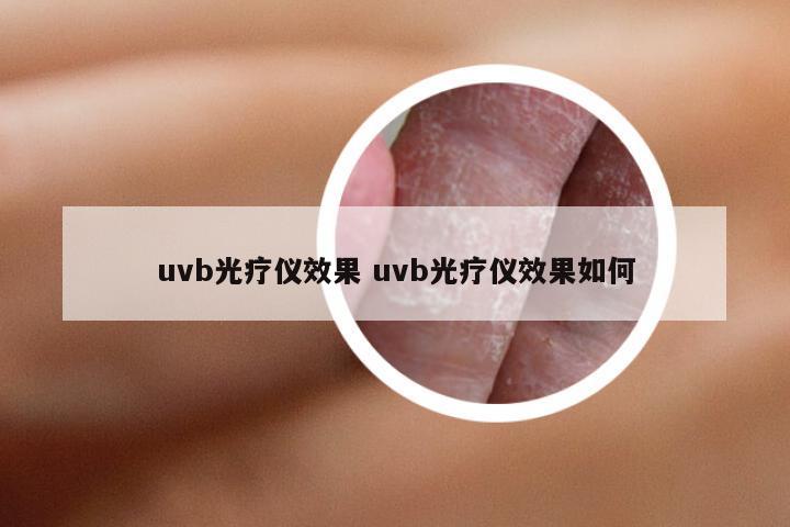 uvb光疗仪效果 uvb光疗仪效果如何