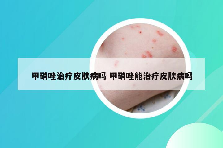 甲硝唑治疗皮肤病吗 甲硝唑能治疗皮肤病吗