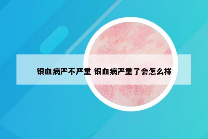 银血病严不严重 银血病严重了会怎么样