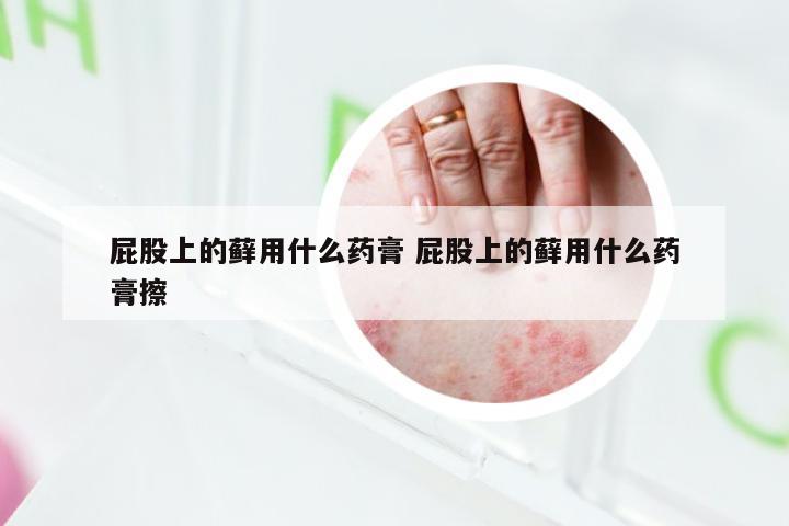 屁股上的藓用什么药膏 屁股上的藓用什么药膏擦