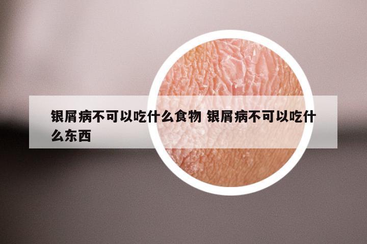 银屑病不可以吃什么食物 银屑病不可以吃什么东西