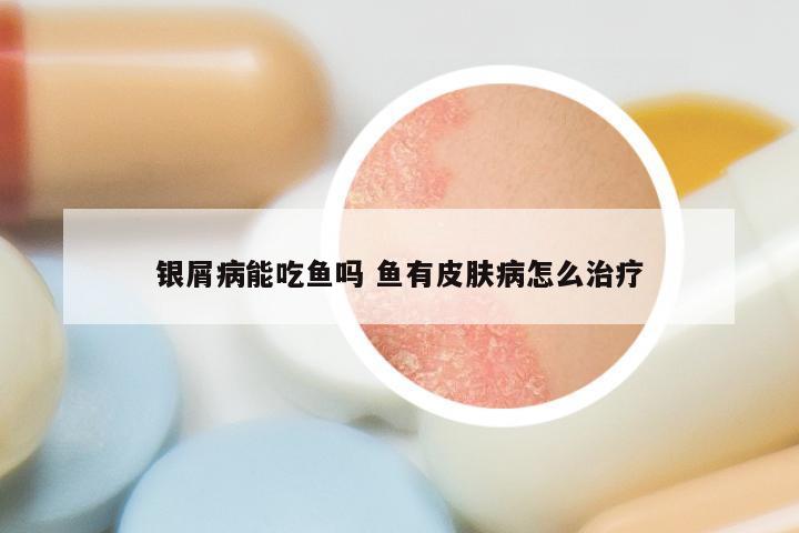 银屑病能吃鱼吗 鱼有皮肤病怎么治疗