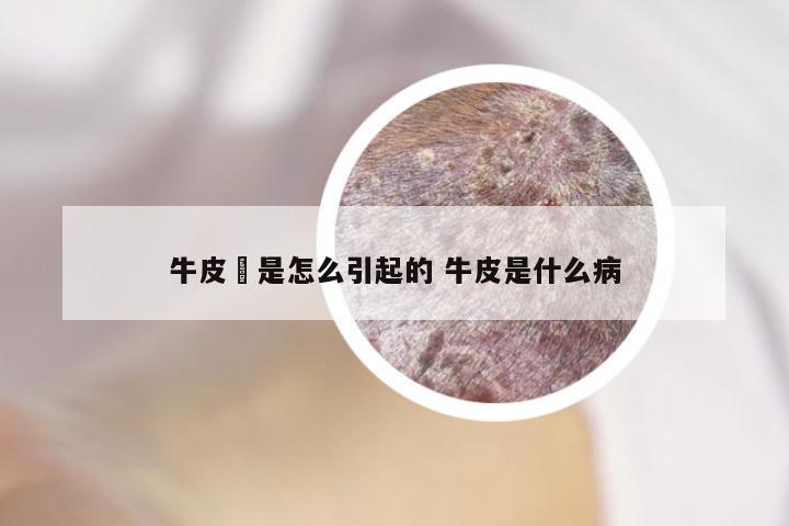 牛皮廯是怎么引起的 牛皮是什么病