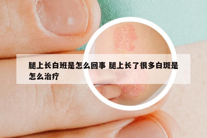 腿上长白班是怎么回事 腿上长了很多白斑是怎么治疗