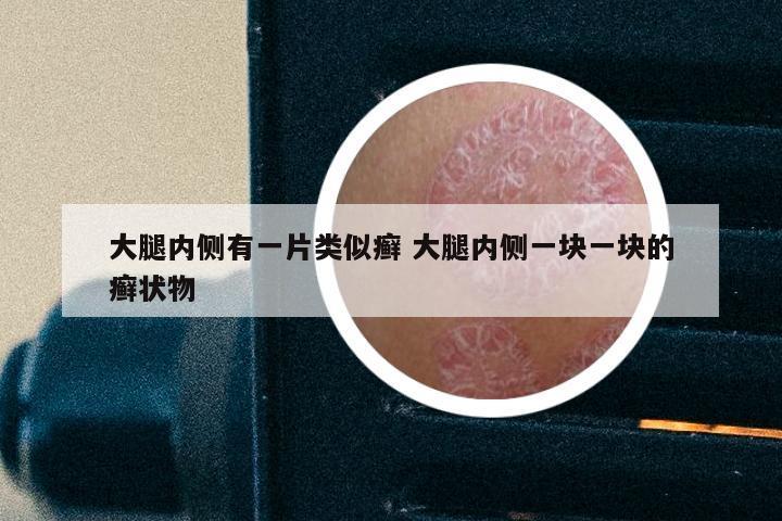 大腿内侧有一片类似癣 大腿内侧一块一块的癣状物