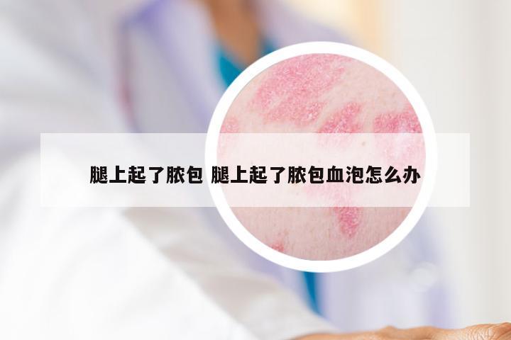 腿上起了脓包 腿上起了脓包血泡怎么办