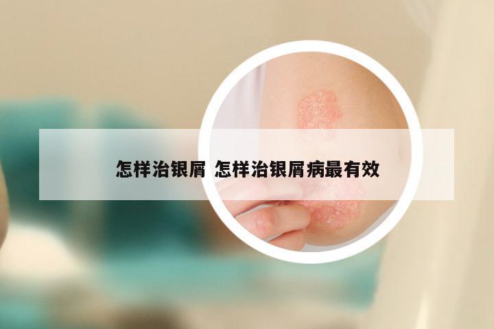 怎样治银屑 怎样治银屑病最有效