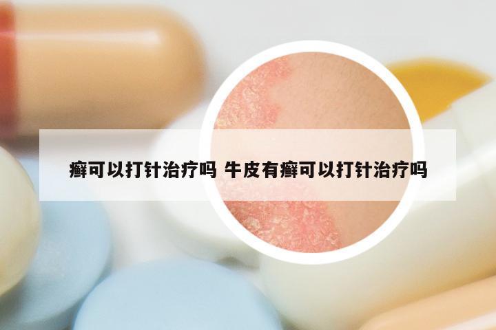 癣可以打针治疗吗 牛皮有癣可以打针治疗吗