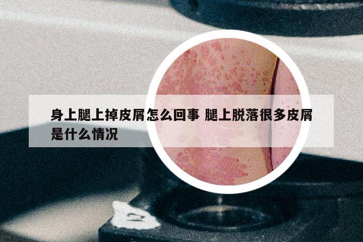 身上腿上掉皮屑怎么回事 腿上脱落很多皮屑是什么情况