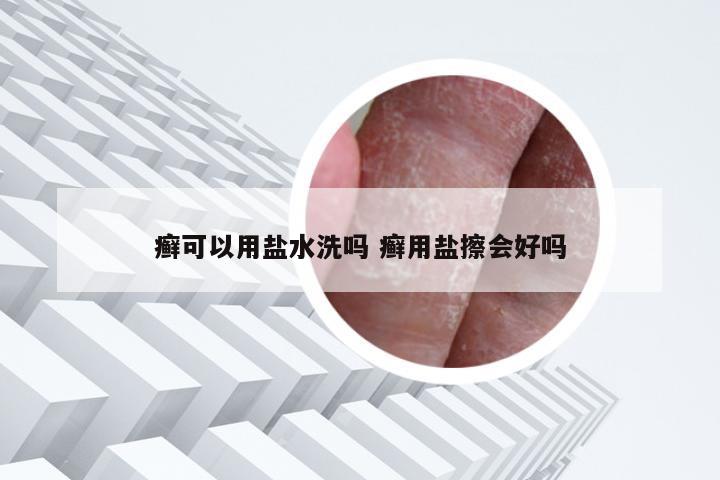 癣可以用盐水洗吗 癣用盐擦会好吗