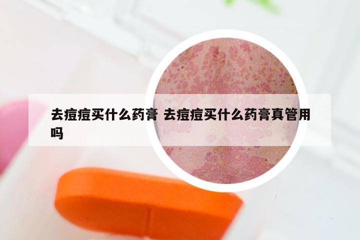 去痘痘买什么药膏 去痘痘买什么药膏真管用吗