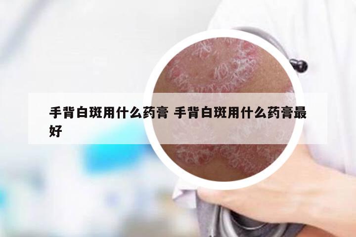 手背白斑用什么药膏 手背白斑用什么药膏最好