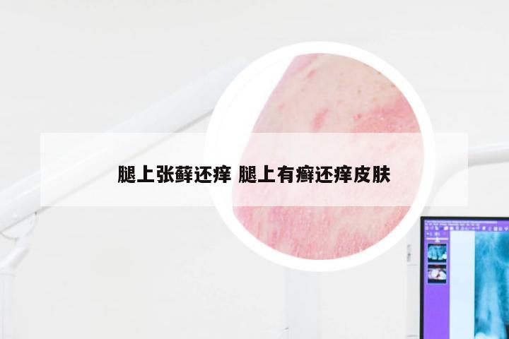 腿上张藓还痒 腿上有癣还痒皮肤