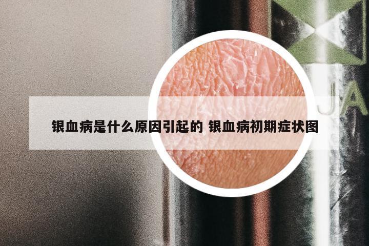 银血病是什么原因引起的 银血病初期症状图