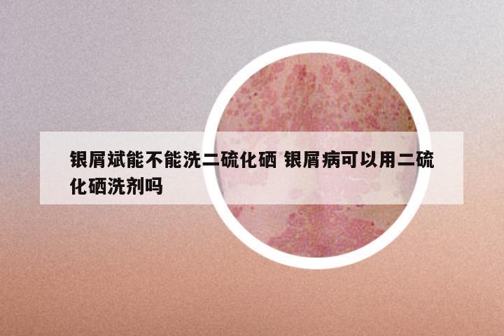 银屑斌能不能洗二硫化硒 银屑病可以用二硫化硒洗剂吗