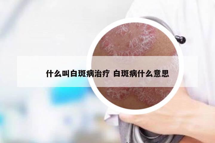 什么叫白斑病治疗 白斑病什么意思