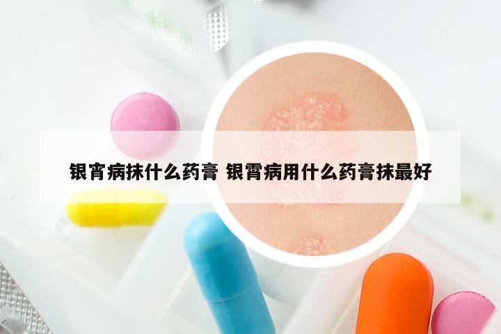 银宵病抹什么药膏 银霄病用什么药膏抹最好