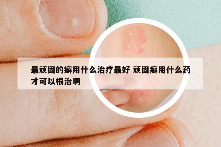 最顽固的癣用什么治疗最好 顽固癣用什么药才可以根治啊