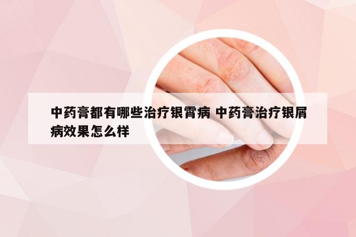 中药膏都有哪些治疗银霄病 中药膏治疗银屑病效果怎么样