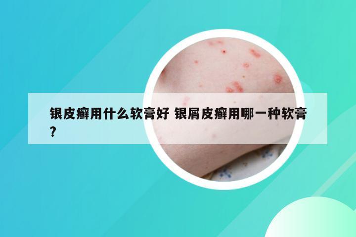 银皮癣用什么软膏好 银屑皮癣用哪一种软膏?