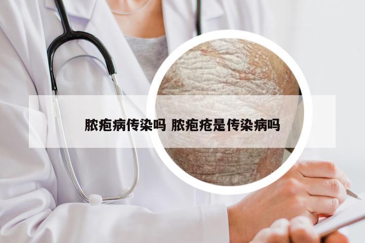 脓疱病传染吗 脓疱疮是传染病吗