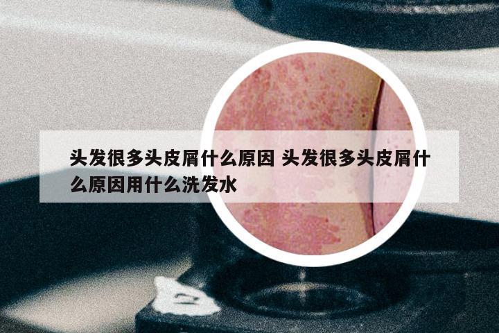 头发很多头皮屑什么原因 头发很多头皮屑什么原因用什么洗发水