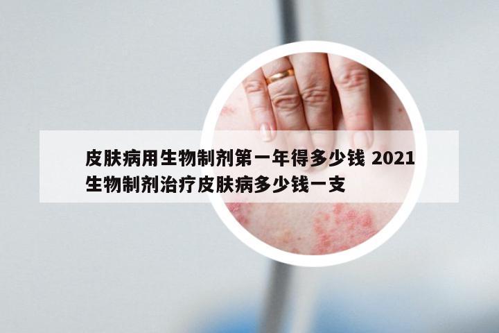 皮肤病用生物制剂第一年得多少钱 2021生物制剂治疗皮肤病多少钱一支