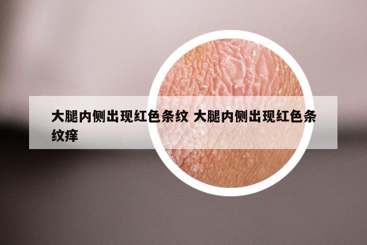 大腿内侧出现红色条纹 大腿内侧出现红色条纹痒