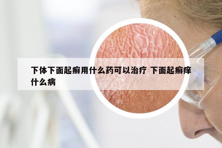 下体下面起癣用什么药可以治疗 下面起癣痒什么病