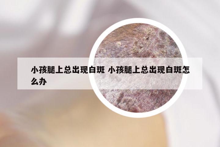 小孩腿上总出现白斑 小孩腿上总出现白斑怎么办