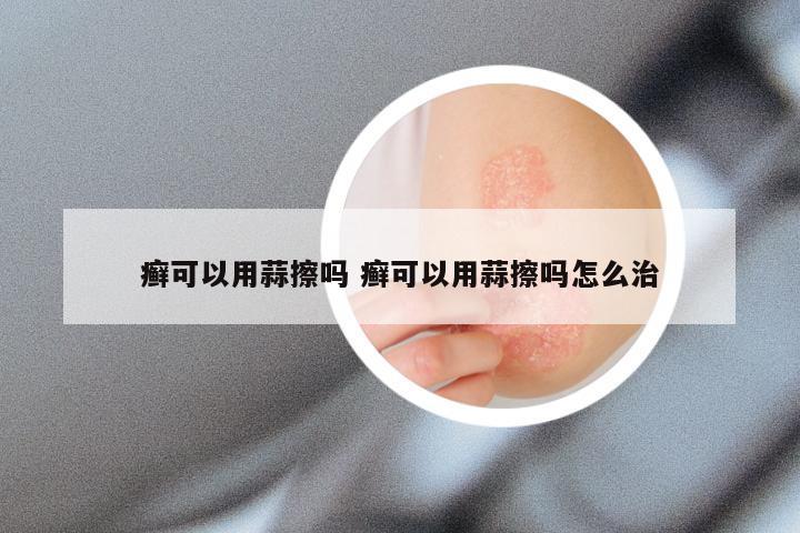 癣可以用蒜擦吗 癣可以用蒜擦吗怎么治