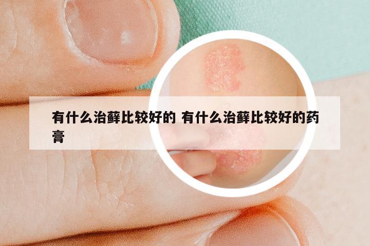 有什么治藓比较好的 有什么治藓比较好的药膏