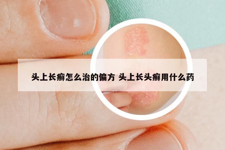 头上长癣怎么治的偏方 头上长头癣用什么药