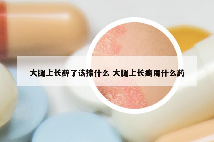 大腿上长藓了该擦什么 大腿上长癣用什么药