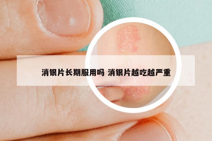 消银片长期服用吗 消银片越吃越严重