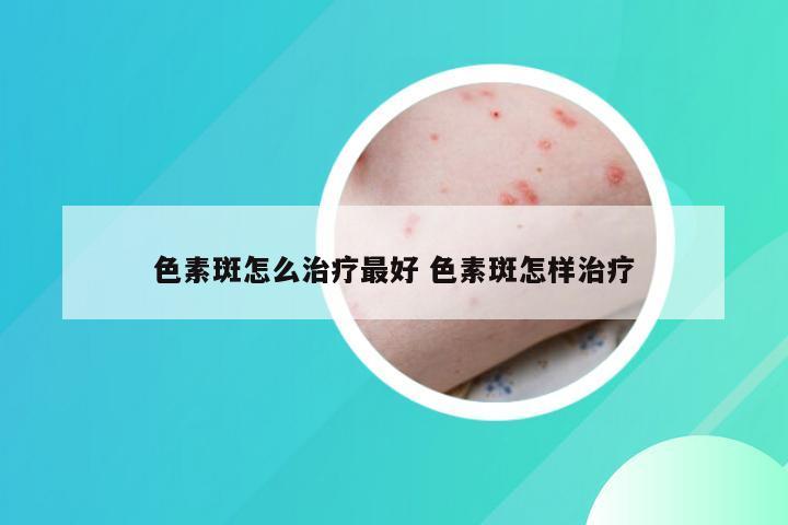 色素斑怎么治疗最好 色素斑怎样治疗