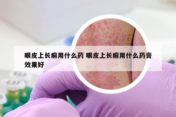 眼皮上长癣用什么药 眼皮上长癣用什么药膏效果好