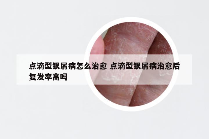 点滴型银屑病怎么治愈 点滴型银屑病治愈后复发率高吗