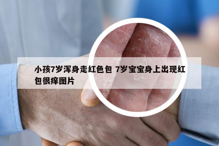 小孩7岁浑身走红色包 7岁宝宝身上出现红包很痒图片