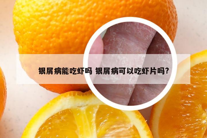 银屑病能吃虾吗 银屑病可以吃虾片吗?