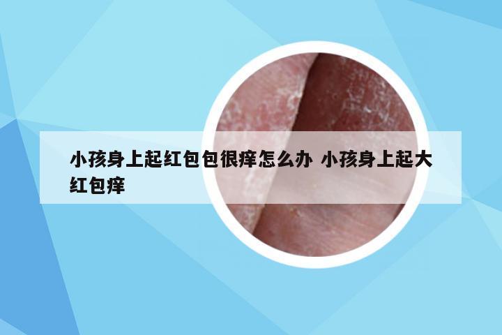 小孩身上起红包包很痒怎么办 小孩身上起大红包痒