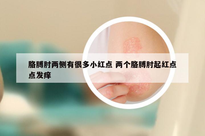 胳膊肘两侧有很多小红点 两个胳膊肘起红点点发痒